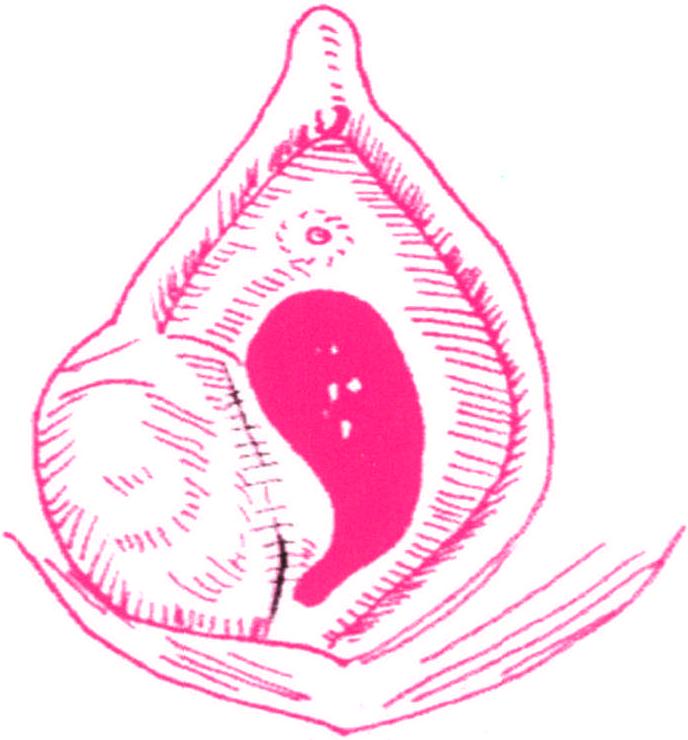 第四节 前庭大腺脓肿切开引流术